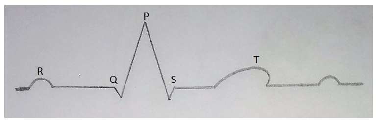 Find the letters marked incorrectly in the given ECG diagram