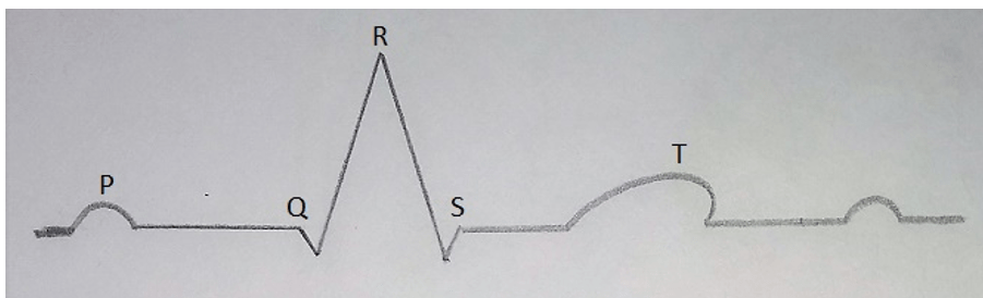 The representation of standard ECG corresponds to a specific electrical activity of heart